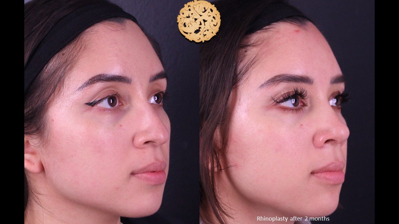 Rhinoplasty Before & After