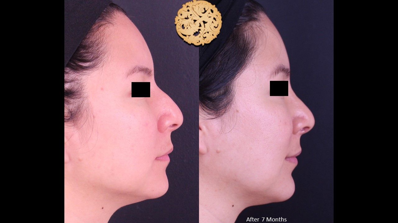 Rhinoplasty Before & After