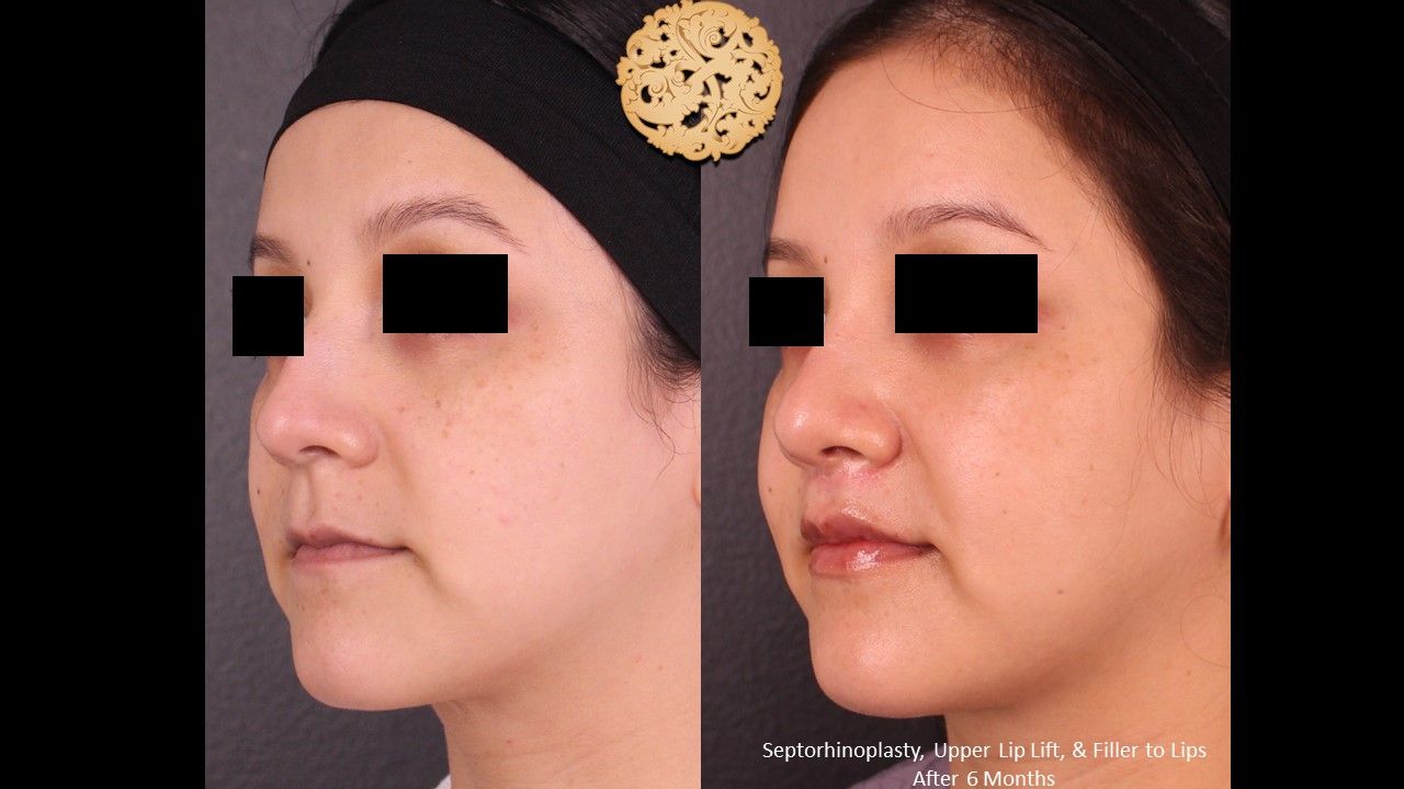 Rhinoplasty Before & After