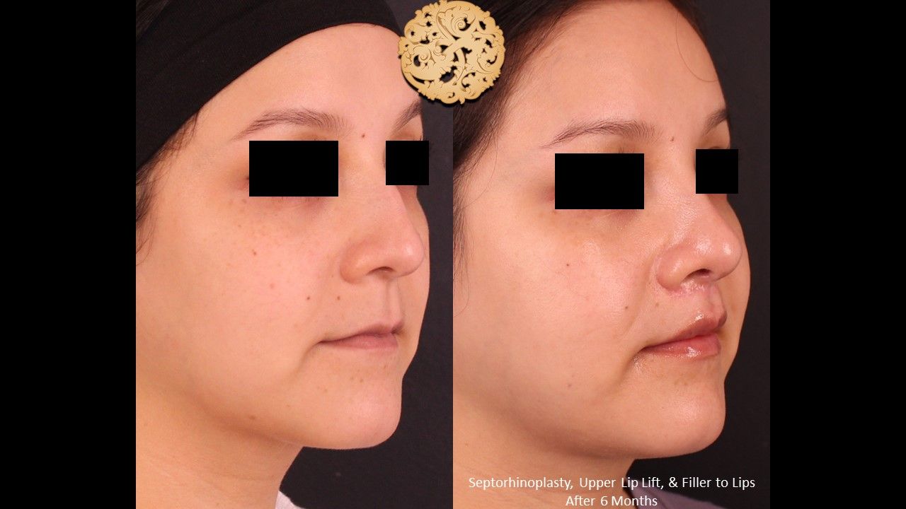Rhinoplasty Before & After