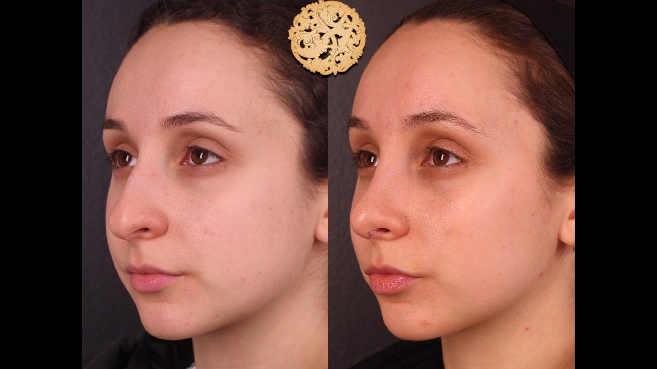 Rhinoplasty Before & After