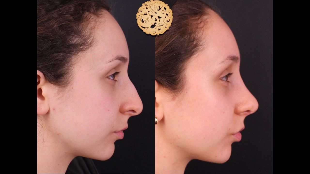 Rhinoplasty Before & After