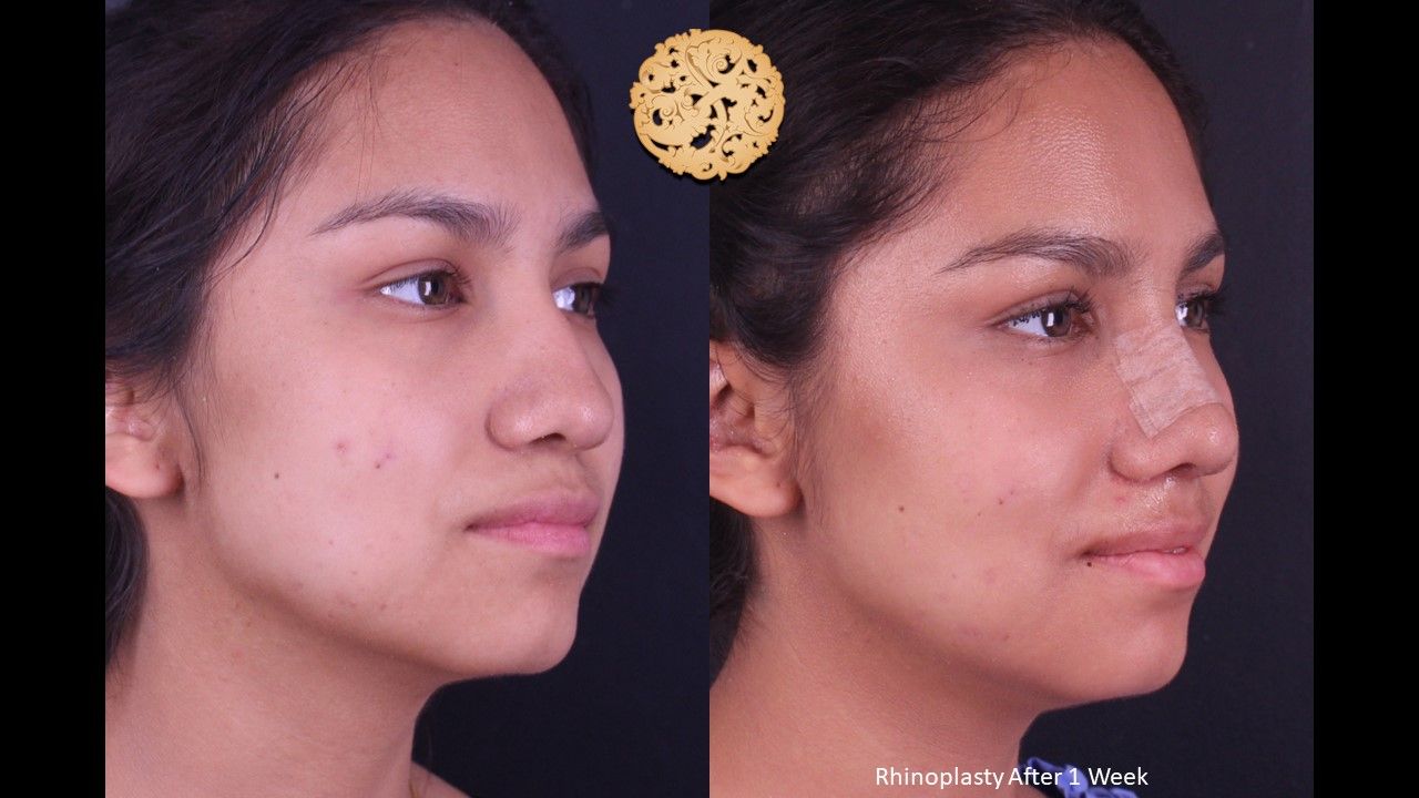 Rhinoplasty Before & After