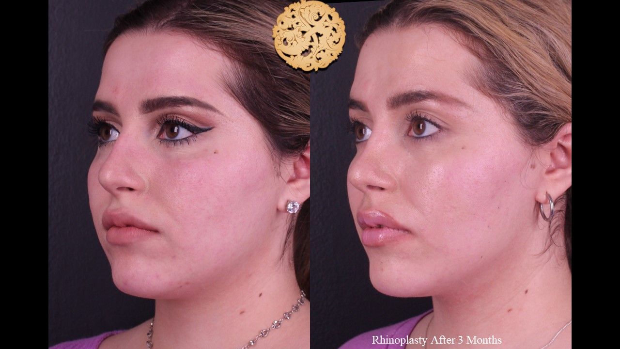 Rhinoplasty Before & After