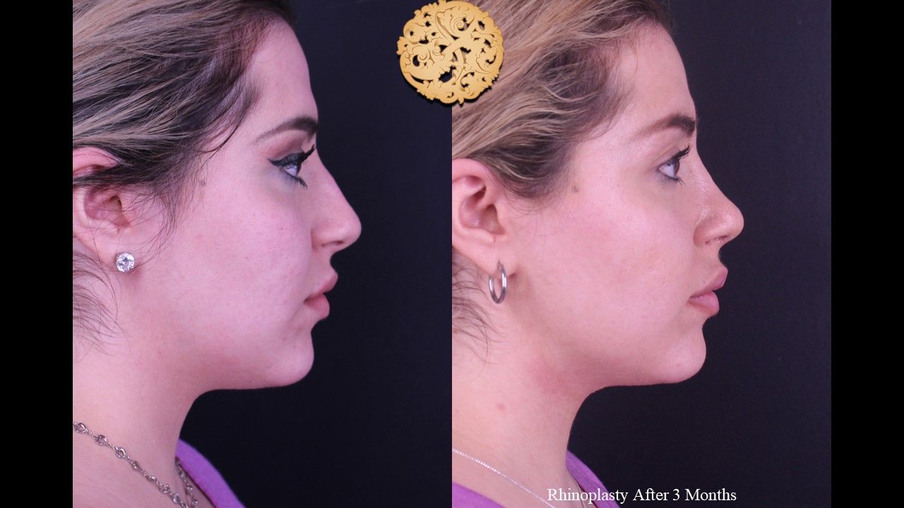 Rhinoplasty Before & After