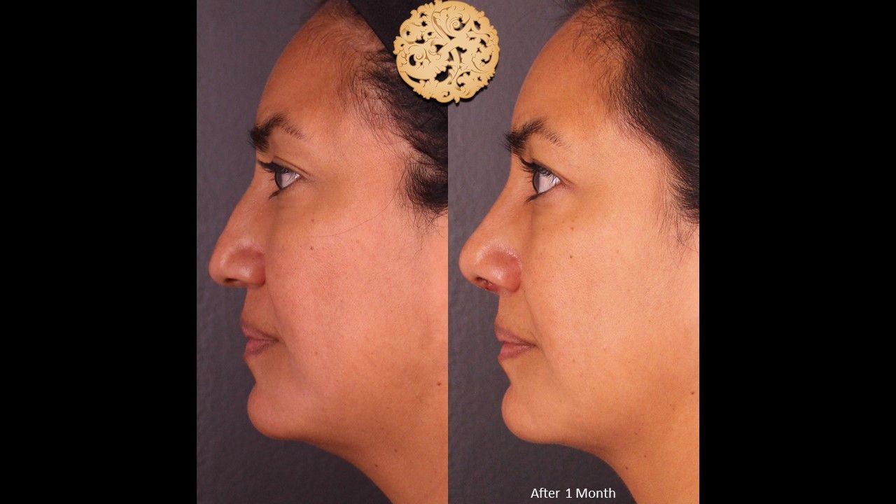 Rhinoplasty Before & After