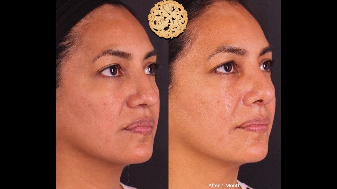 Rhinoplasty Before & After