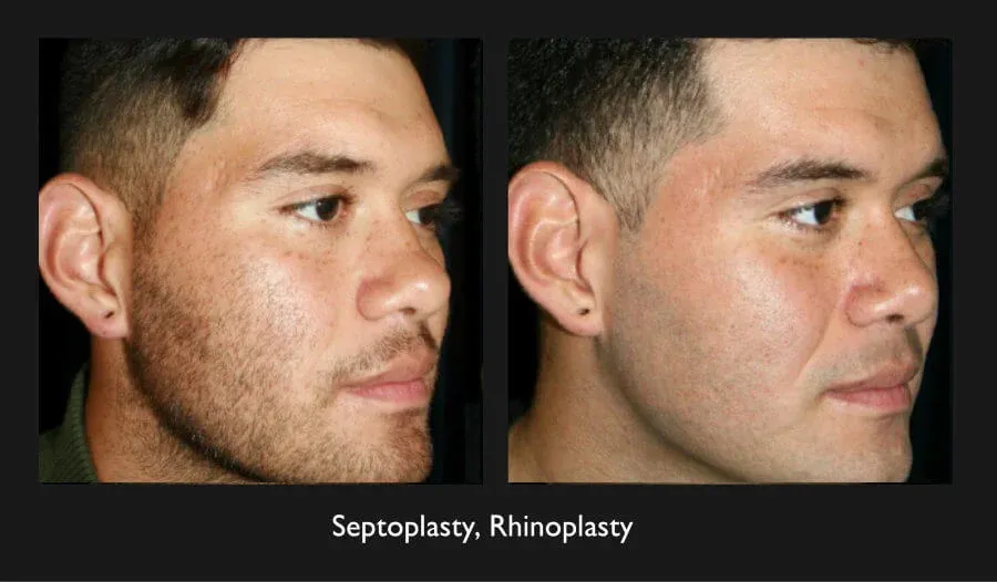 Rhinoplasty Before & After