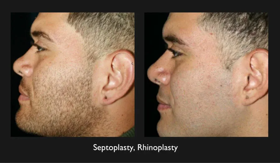 Rhinoplasty Before & After
