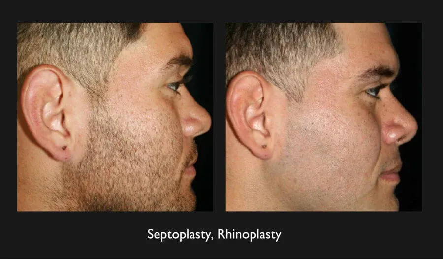 Rhinoplasty Before & After