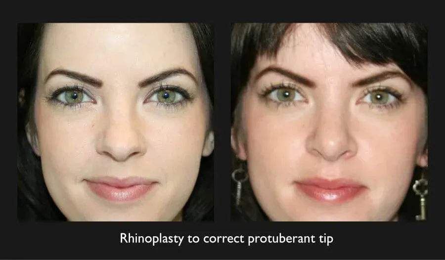 Rhinoplasty Before & After