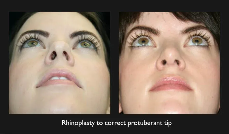 Rhinoplasty Before & After