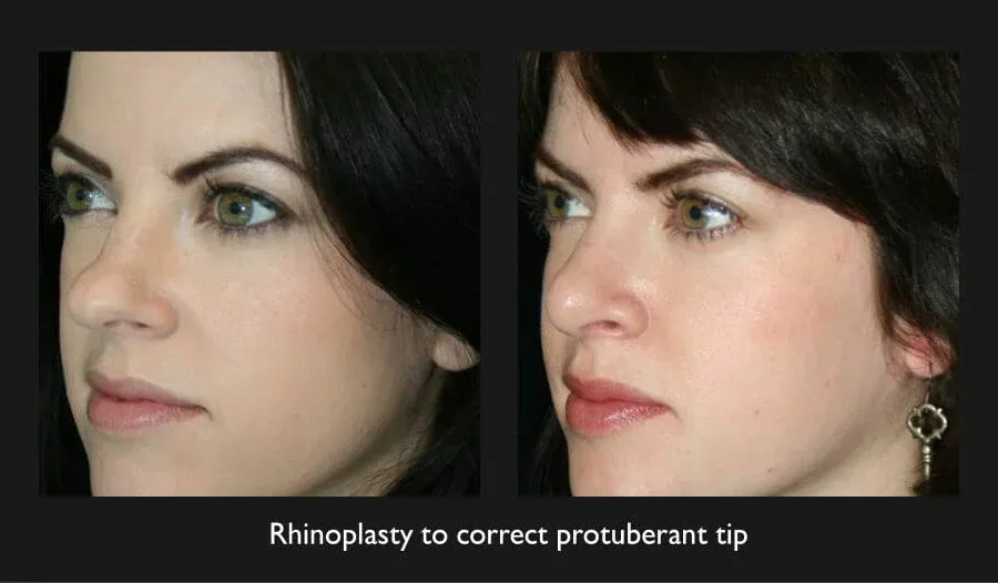 Rhinoplasty Before & After