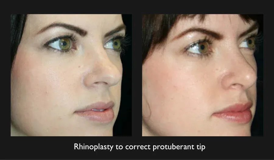 Rhinoplasty Before & After
