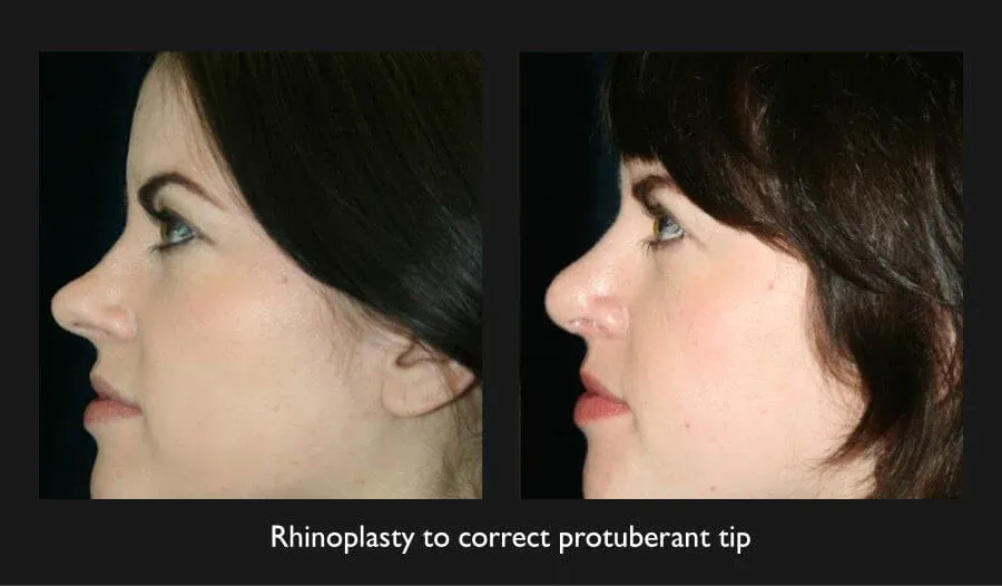 Rhinoplasty Before & After