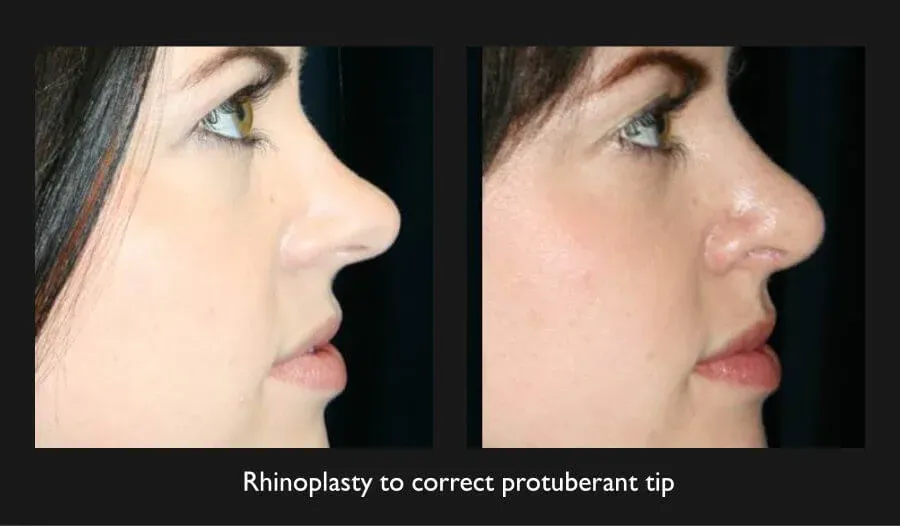 Rhinoplasty Before & After
