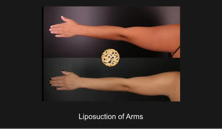 Liposuction Before & After