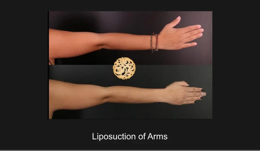 Liposuction Before & After