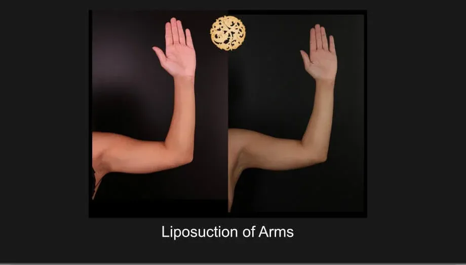 Liposuction Before & After