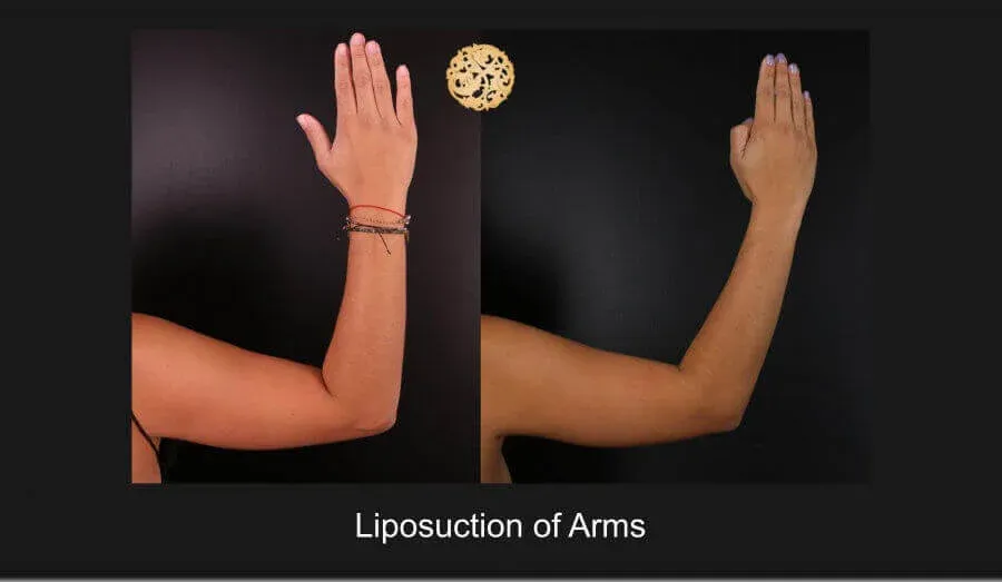 Liposuction Before & After