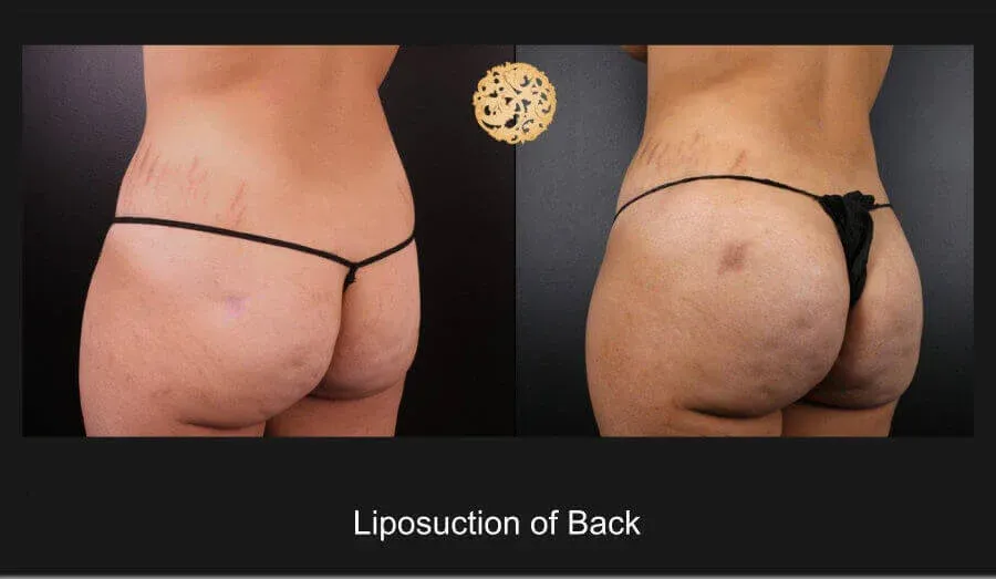 Liposuction Before & After
