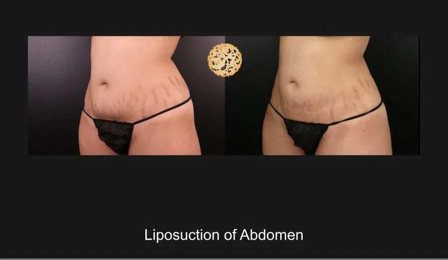 Liposuction Before & After