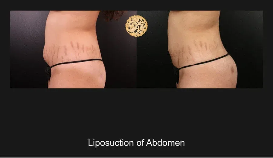 Liposuction Before & After