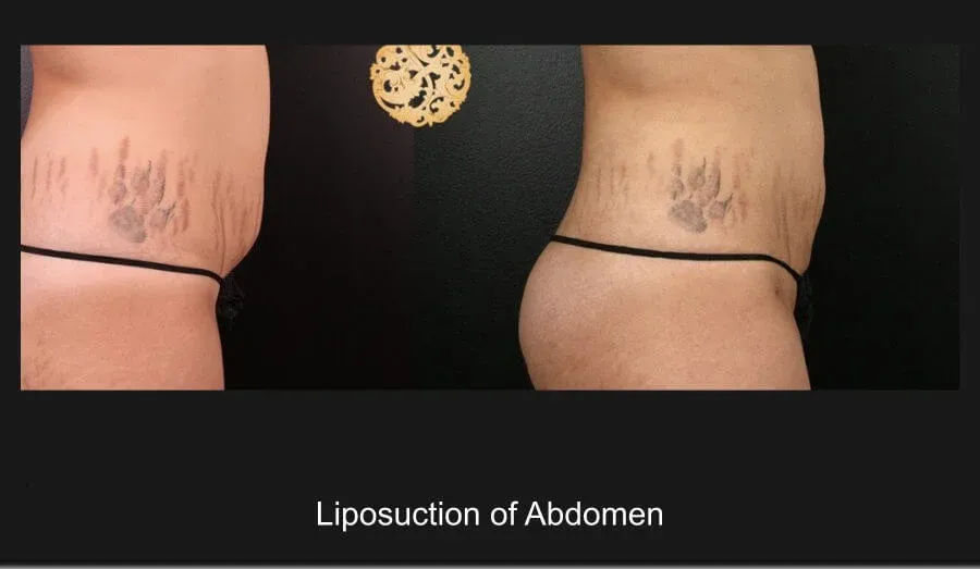 Liposuction Before & After