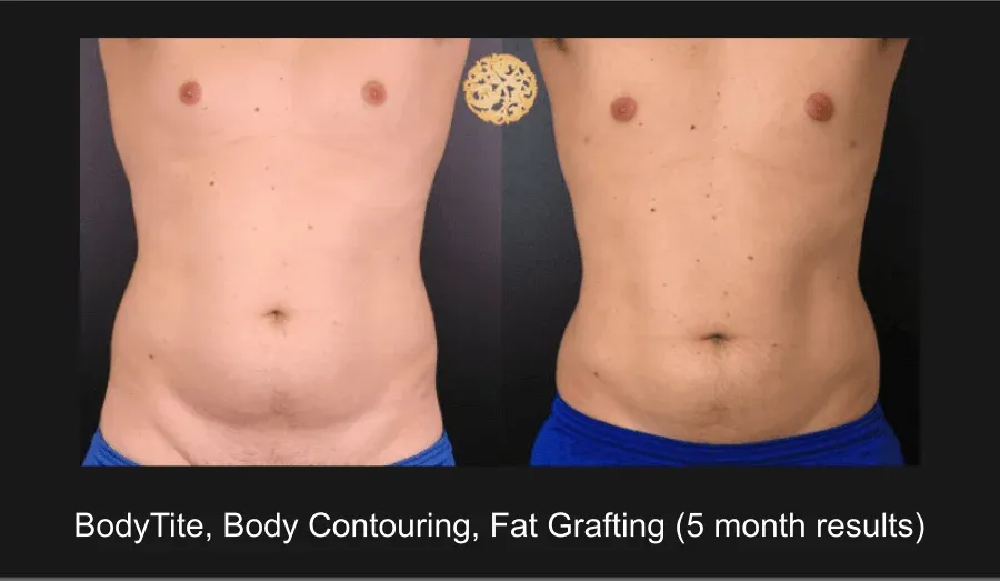 Liposuction Before & After