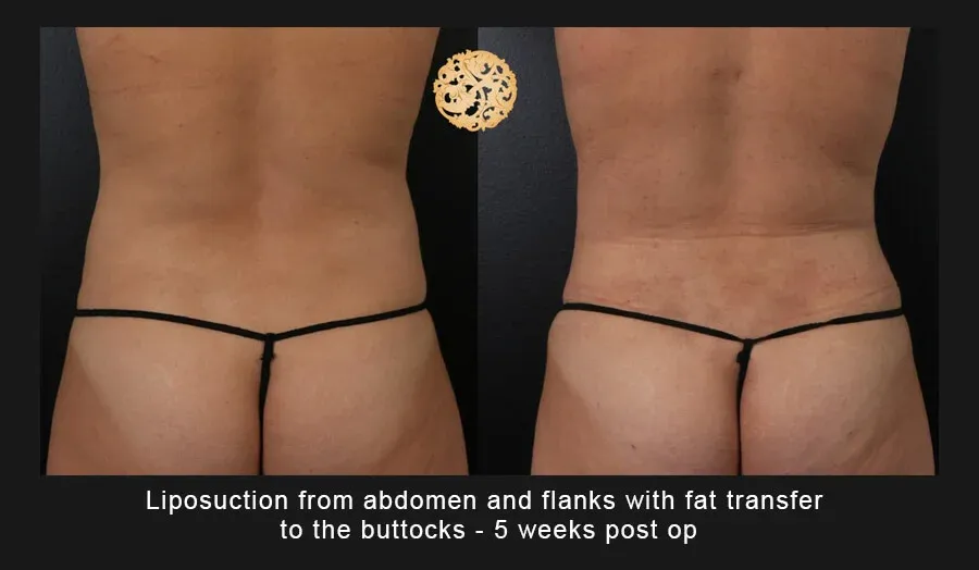 Liposuction Before & After