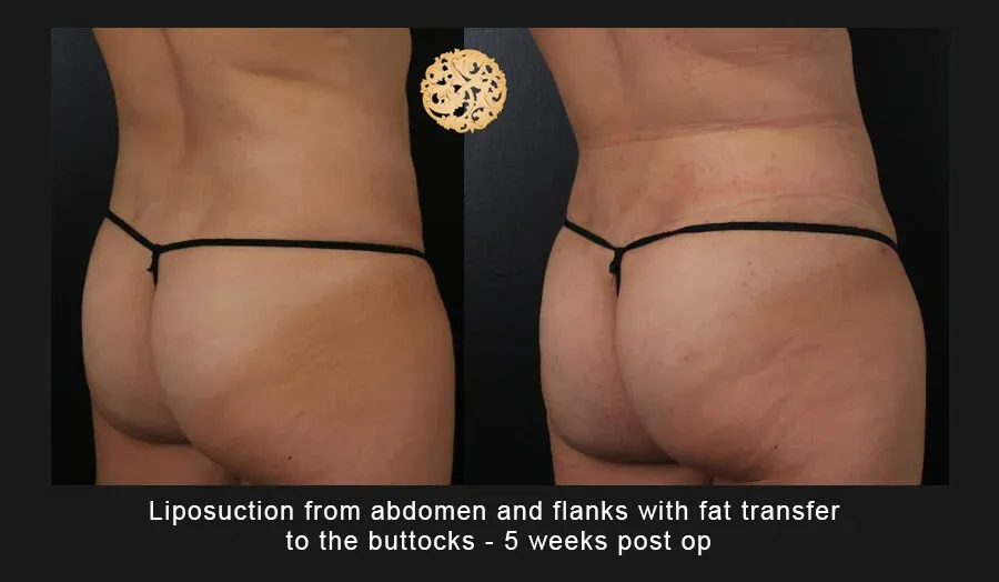 Liposuction Before & After