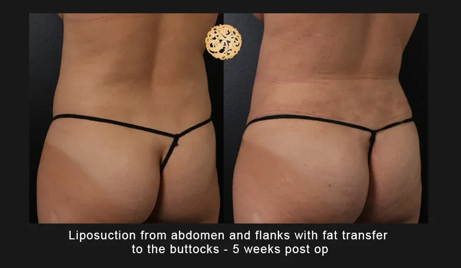 Liposuction Before & After