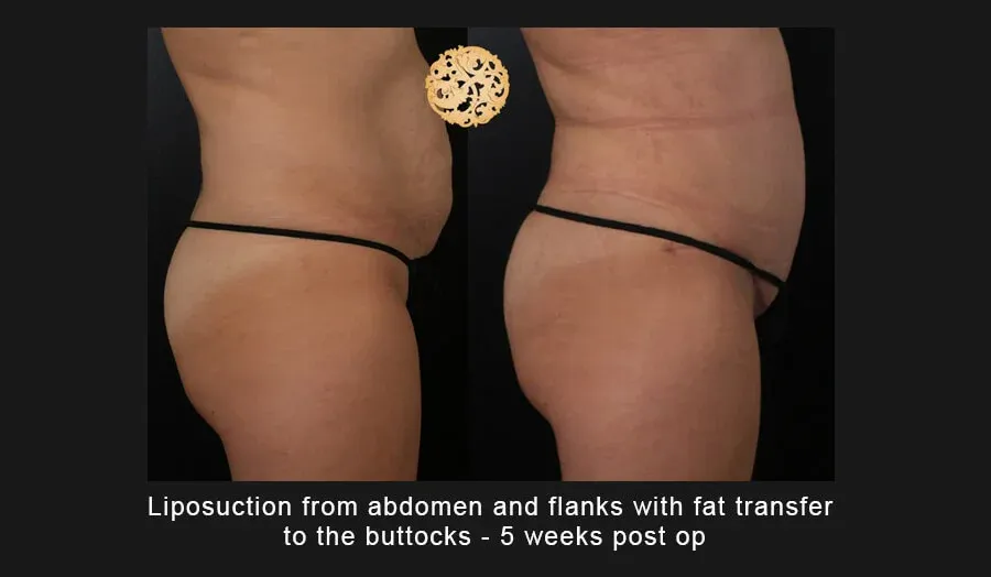 Liposuction Before & After