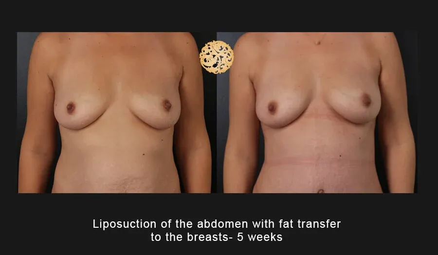 Liposuction Before & After
