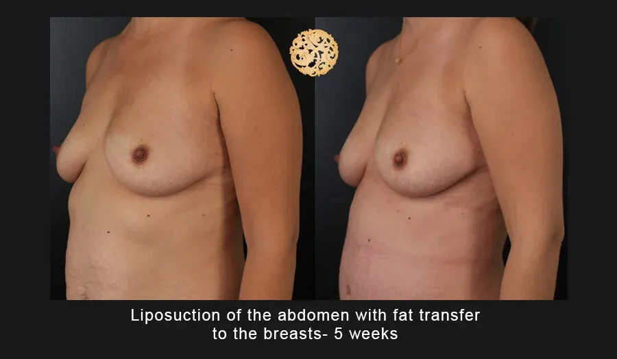 Liposuction Before & After