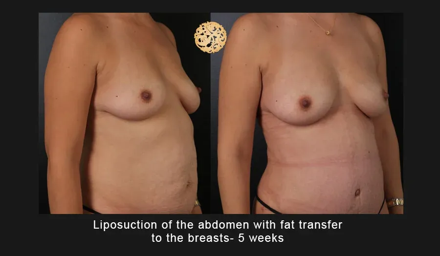 Liposuction Before & After
