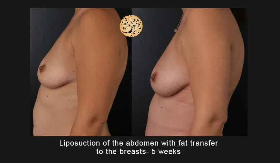 Liposuction Before & After