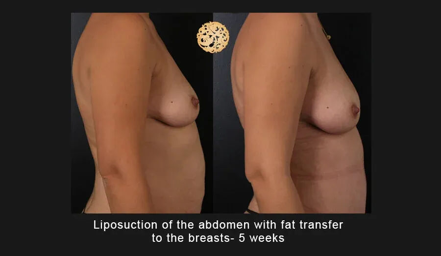 Liposuction Before & After