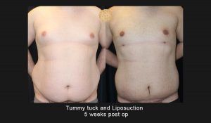 Liposuction Before & After