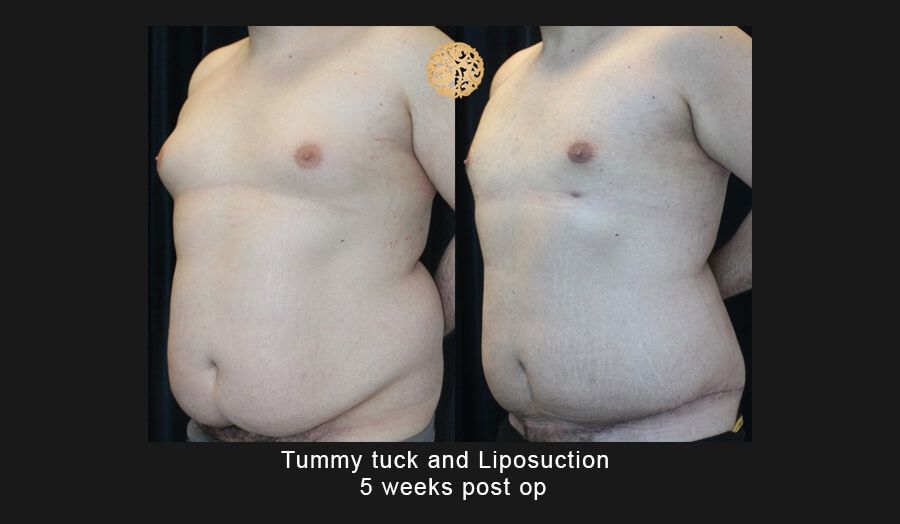 Liposuction Before & After