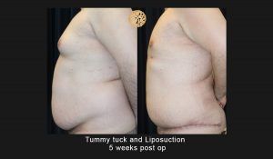 Liposuction Before & After