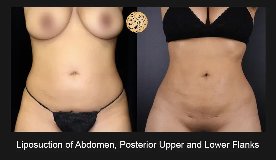Liposuction Before & After