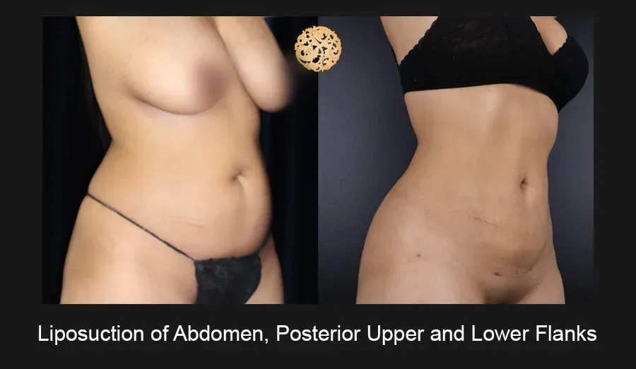 Liposuction Before & After