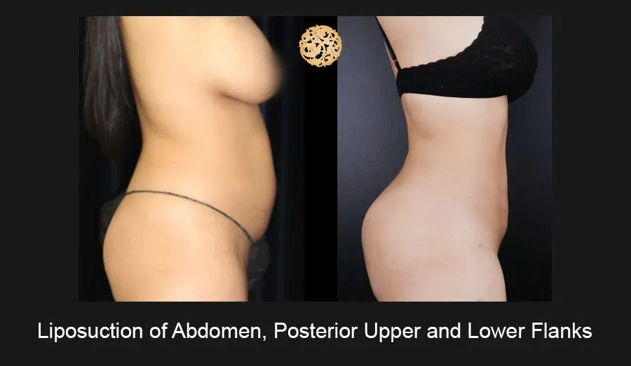 Liposuction Before & After