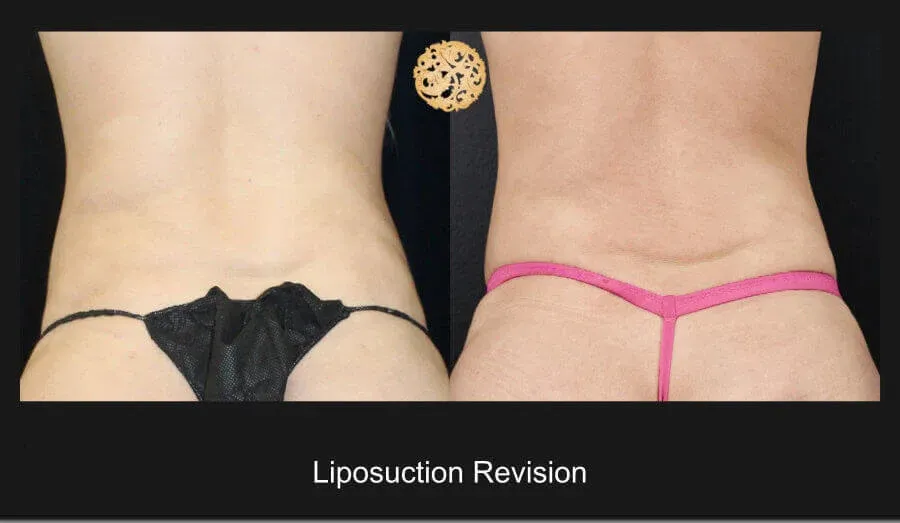 Liposuction Before & After
