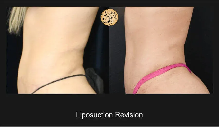 Liposuction Before & After