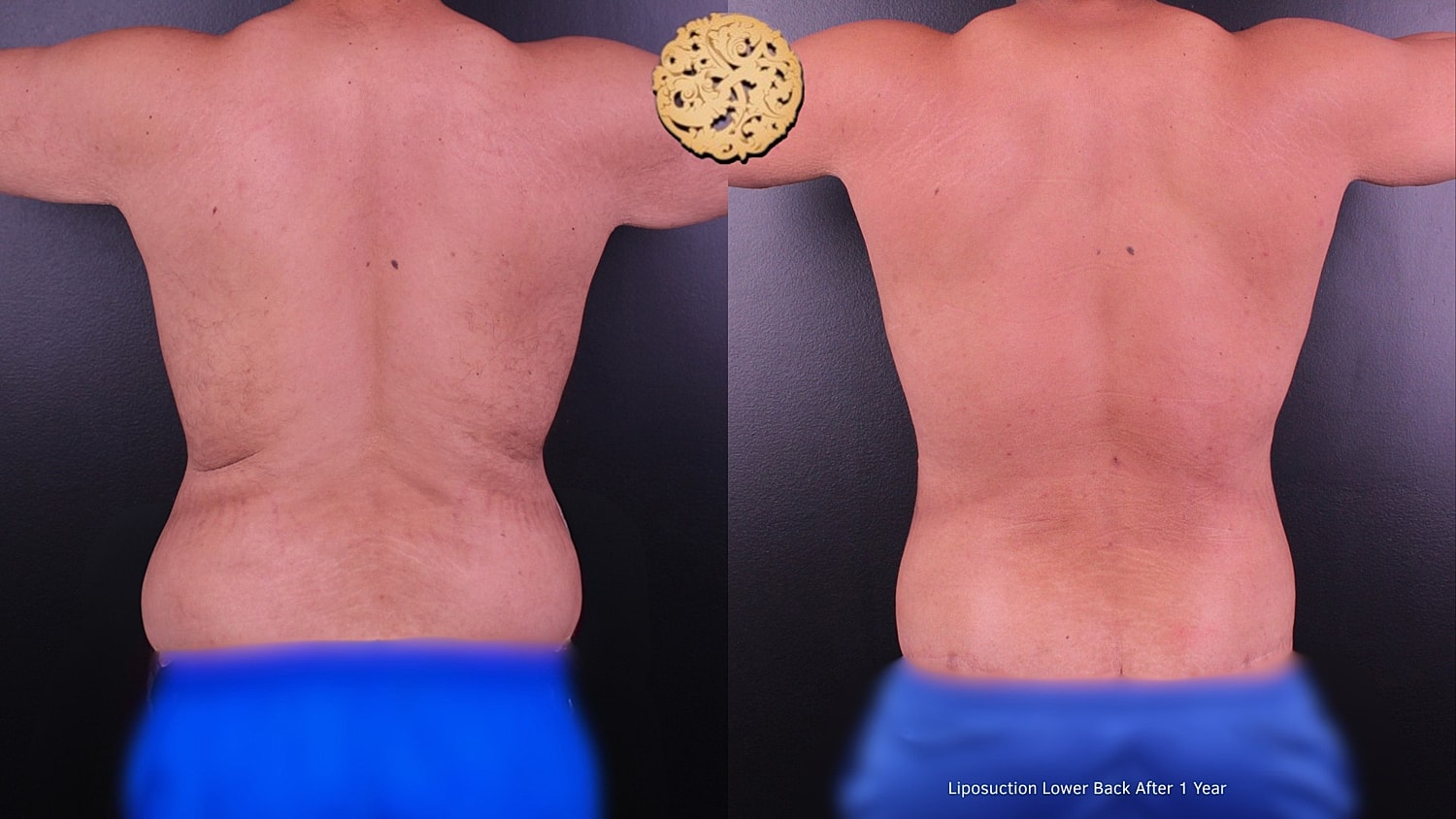 Liposuction lower back results after one year.