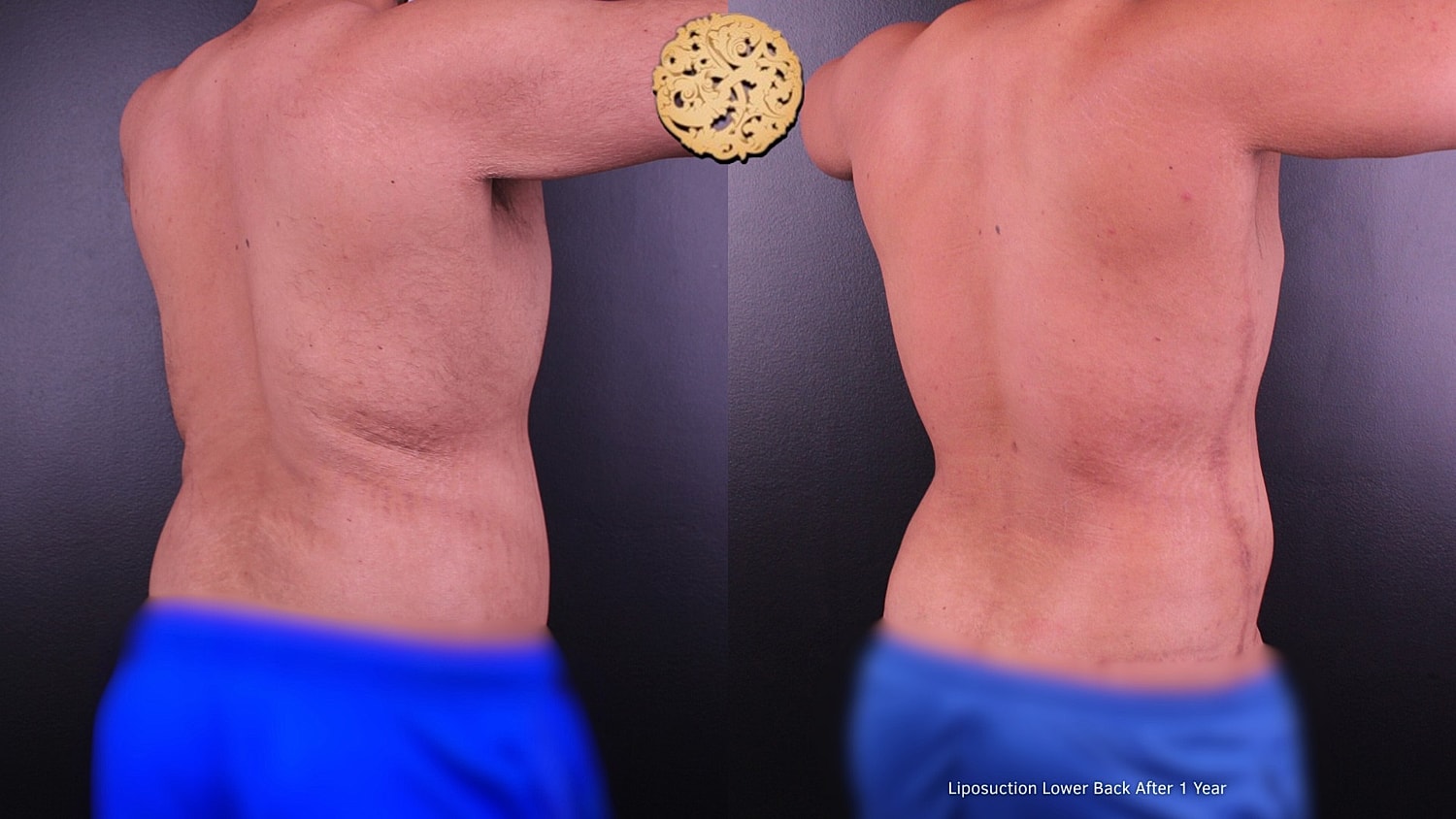 Liposuction results on lower back after one year.