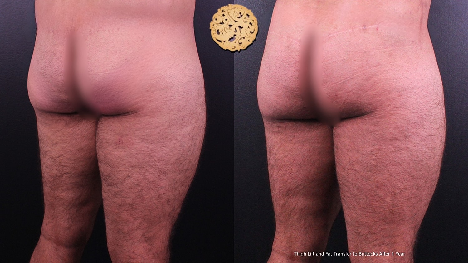 Post-surgery thigh lift and fat transfer results.