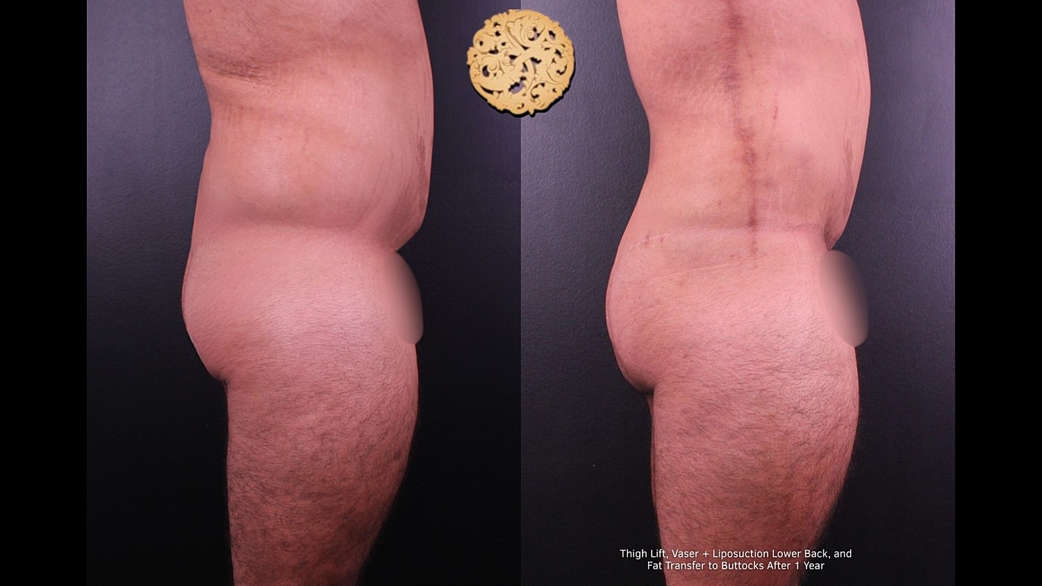 Before and after body contouring procedure results.